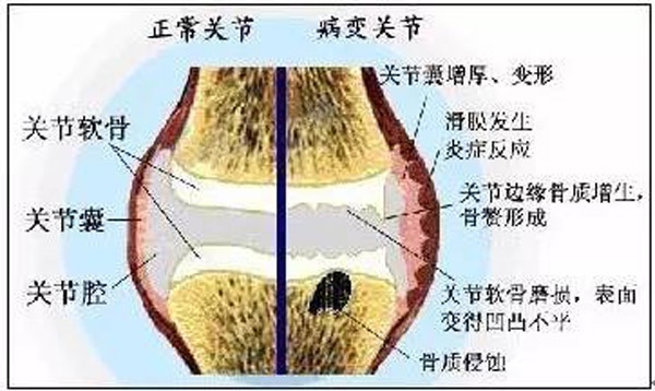 关于膝关节：烦人的“膝盖积水”到底从哪儿来？