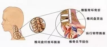走出颈椎病的诊治误区,科学预防颈椎病